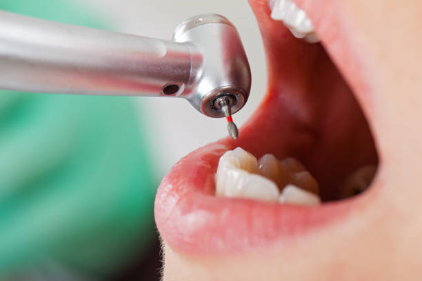 Best Emergency Wisdom Teeth Removal in Newhall, IA